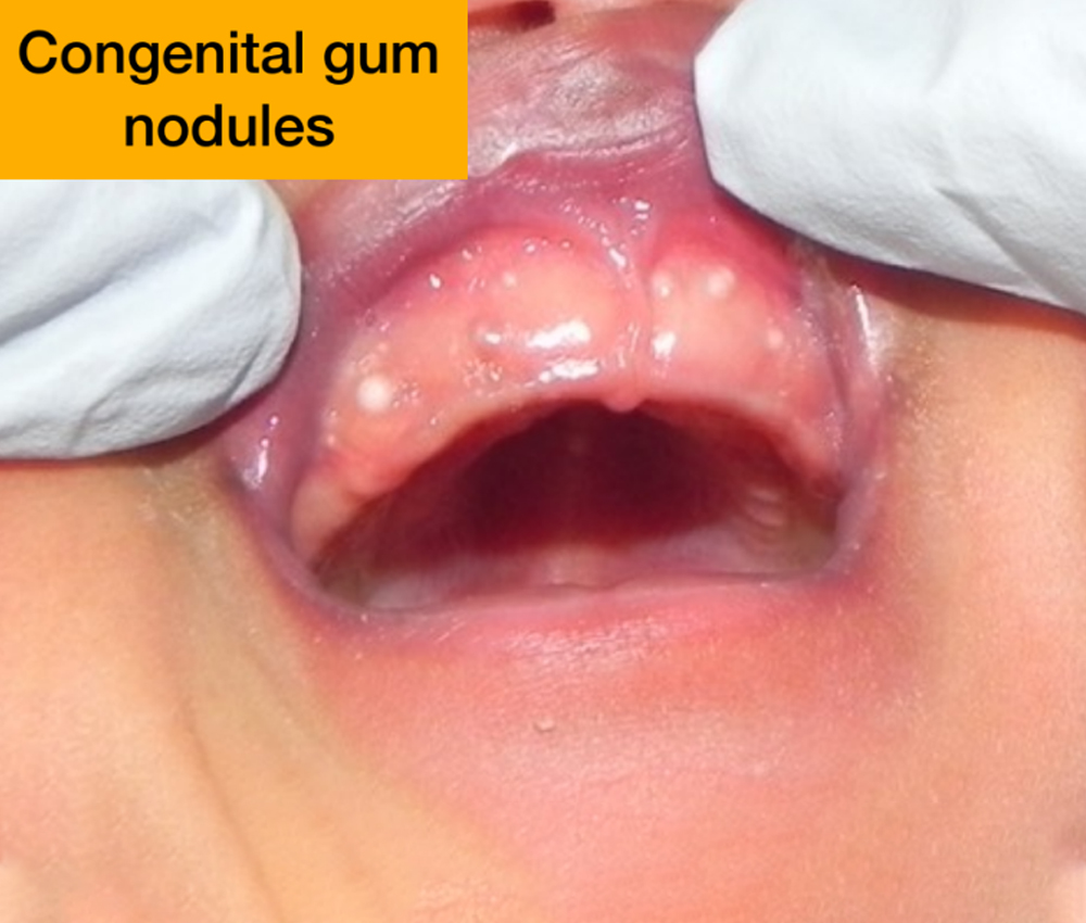 Dental Implants